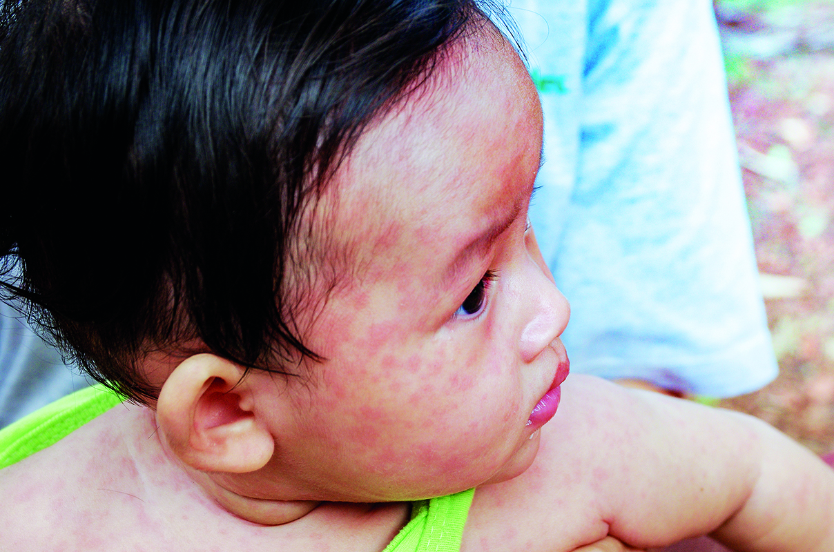 Close up of the face of a child showing red, blotchy marks of measles.
