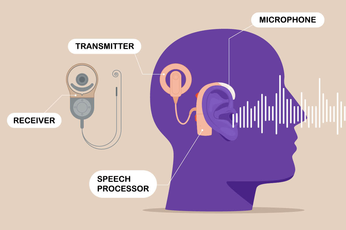 Illustration of the anatomy of a cochlear implant